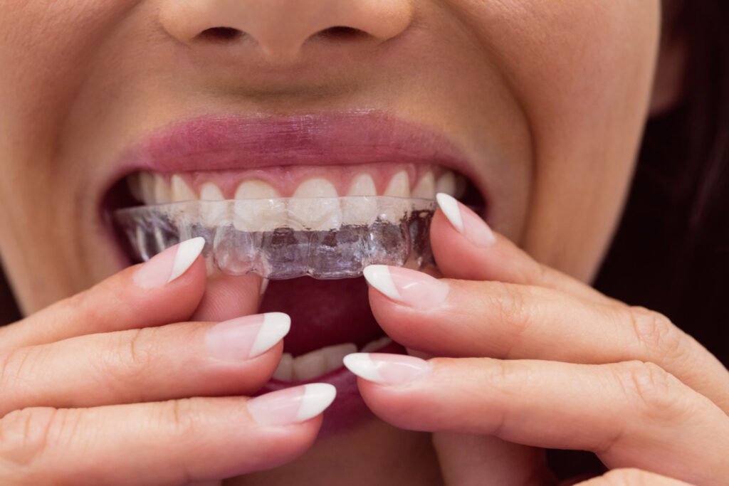 Clear Aligners vs Braces