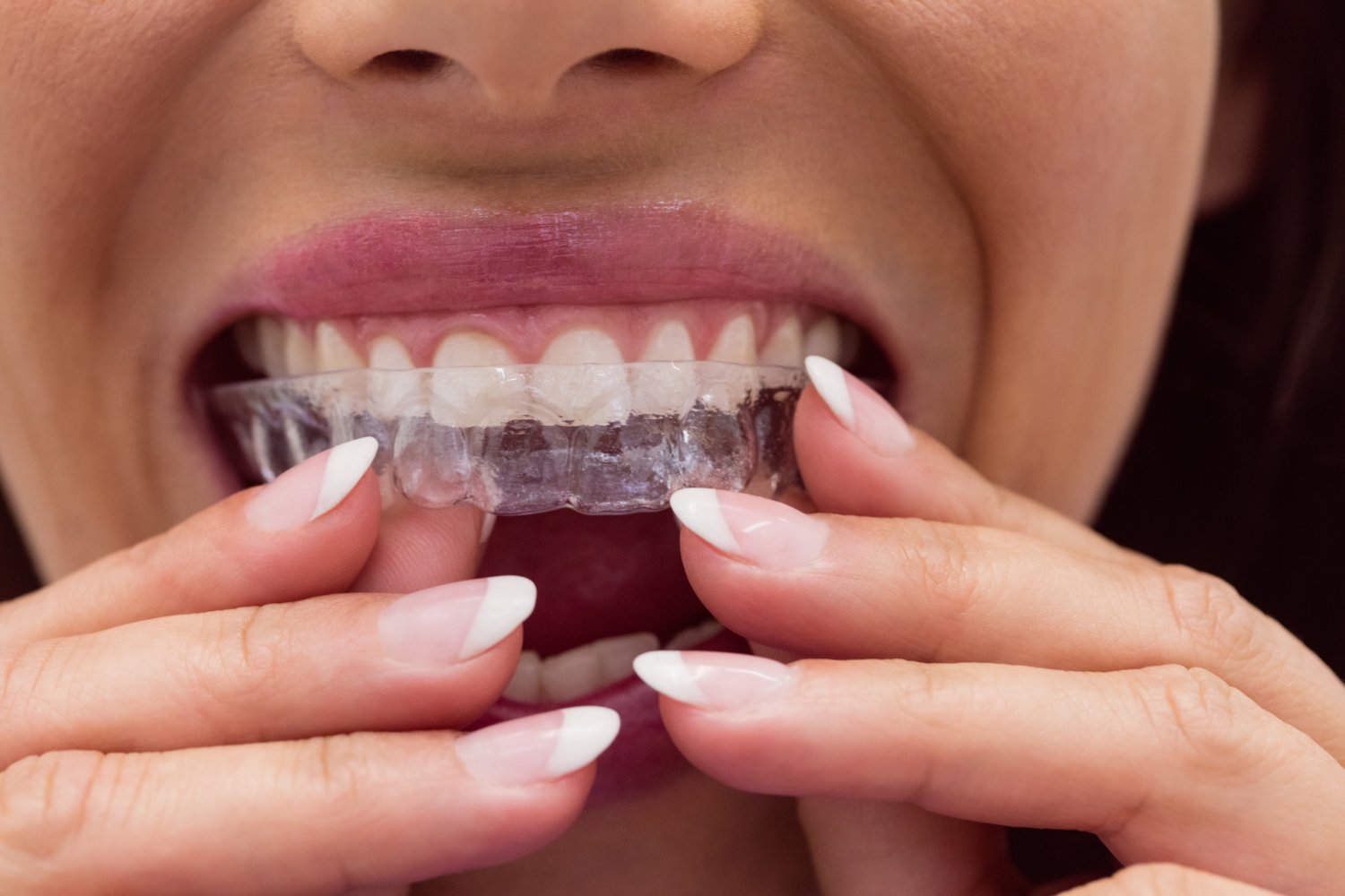 Invisalign for Teens in Lagos